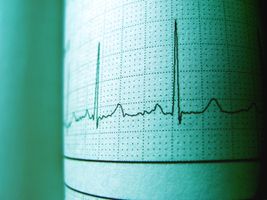 New Real-World Study Links Tirzepatide to Fewer Heart Attacks in Type 2 Diabetes
