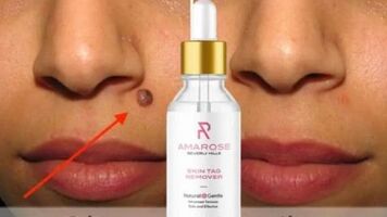 U Renew Skin Tag Remover ca Reviews – Shark Tank Price, Benefits, Ingredients, Side Effects & Huge Discount