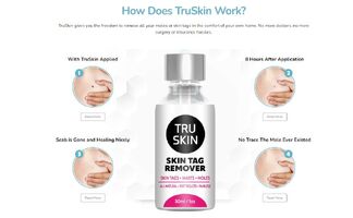TruSkin Skin Tag Remover Reviews