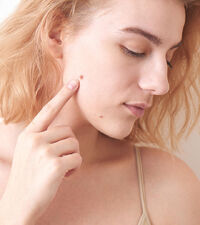 Cryogen Skin Tag Remover: (2023 New Update)Try It Today, Risk-Free!