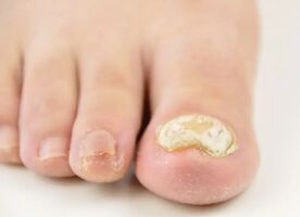 What Are Treatments For Kill Nail Fungus?