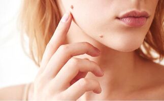 Clean as Teen Skin Tag Remover: Get to results quickly!