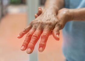 Rheumatoid Arthritis